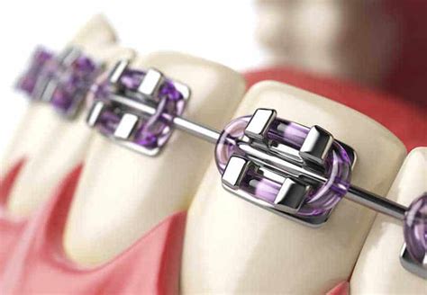 types of metal dental brackets|recent advances in orthodontic brackets.